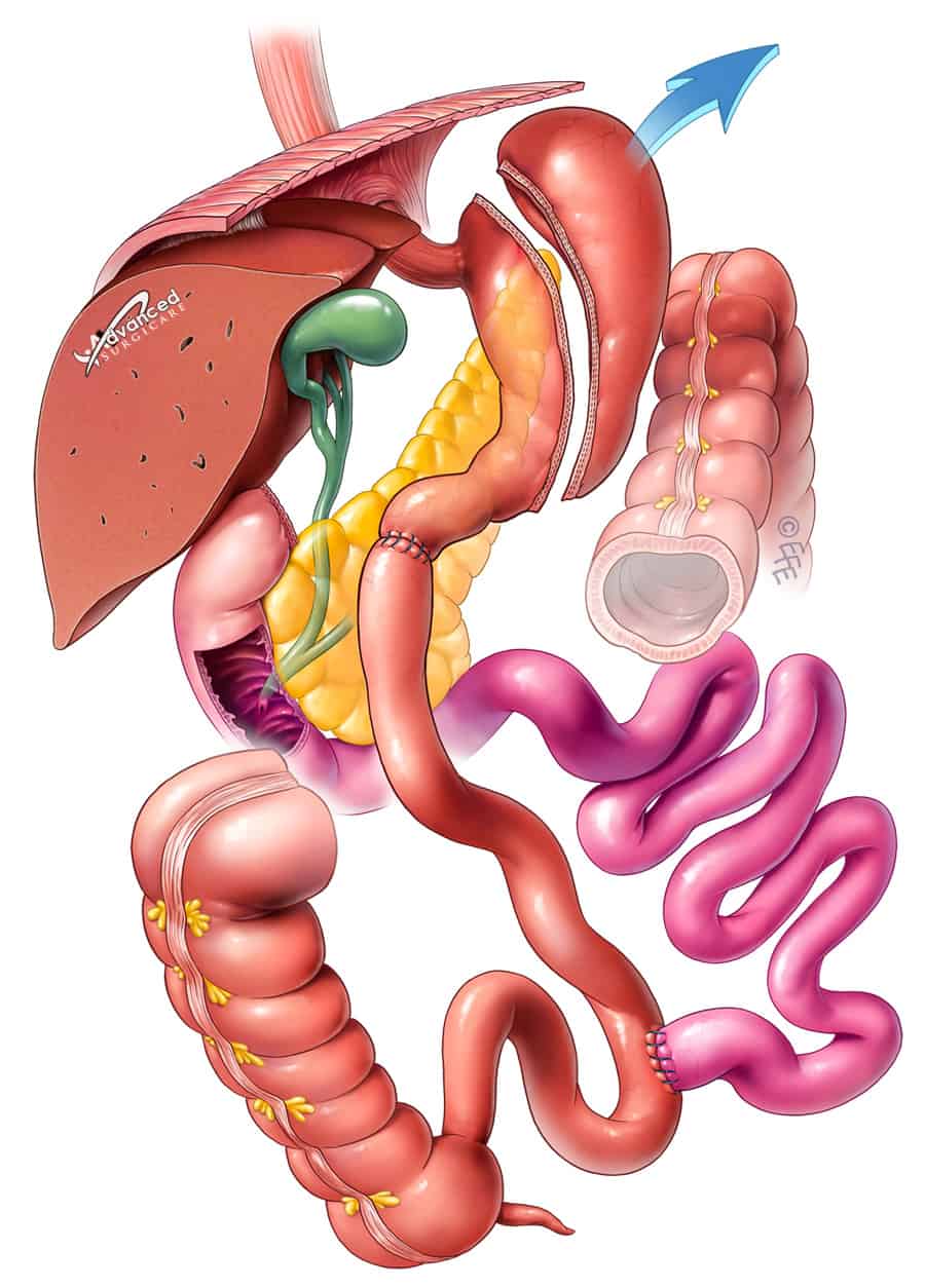 lap biliopancreatic diversion sydney lap duodenal switch sydney