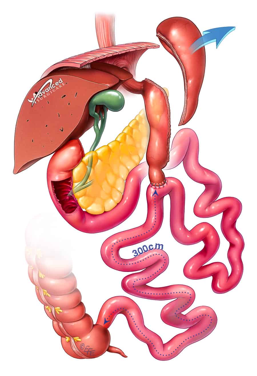 Laparoscopic SADI-S Surgery Sydney - Single anastomosis duodeno–ileal Laparoscopic SADI-S Surgery Sydney - Single anastomosis duodeno–ileal